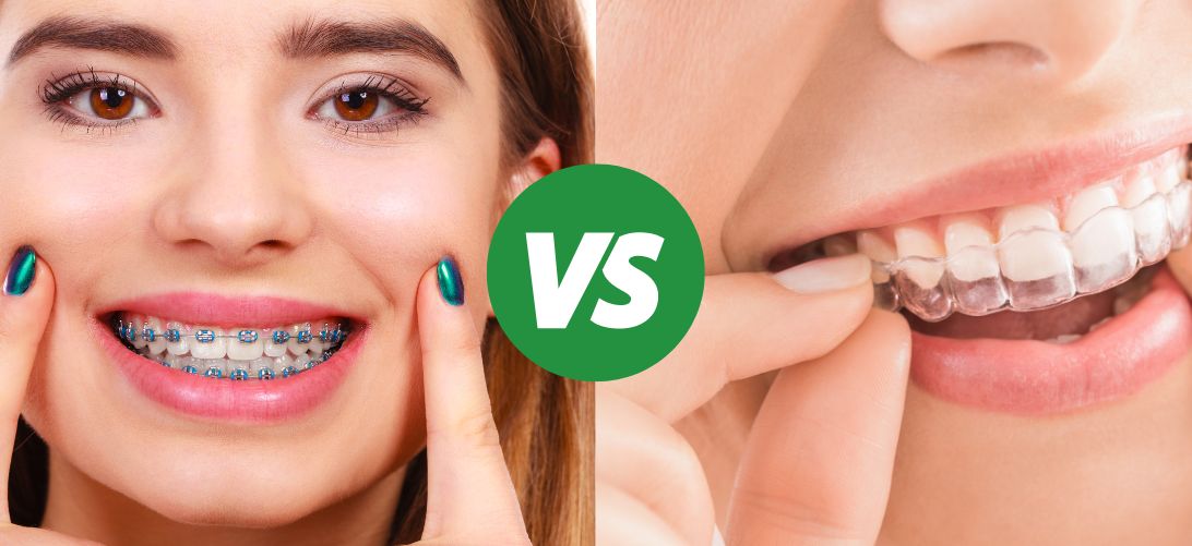 Invisalign vs. Brackets