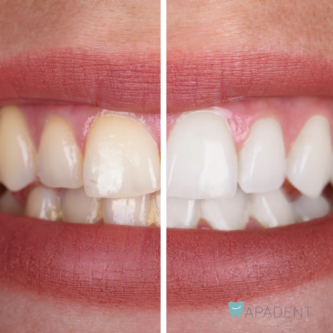 APADENT - 2
