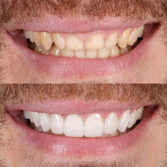 Carillas Dentales AD Oliva