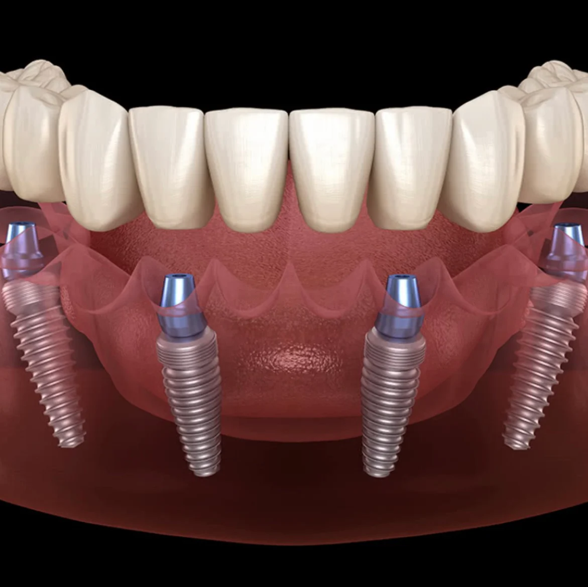 Clínica Dental CEID * Dentista en Barcelona | Implantes Dentales | Carillas | Ortodoncia - 2