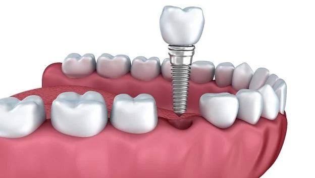Clínica Dental Implantdent Palamos - 2