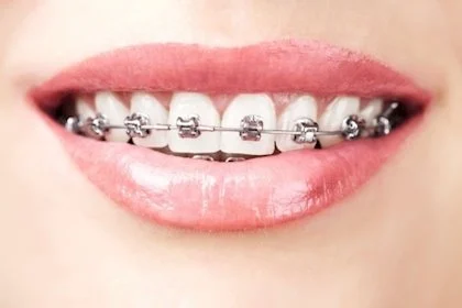 Clínica Dental San Magno | Expertos Estética Dental | Ortodoncia Invisible - 2