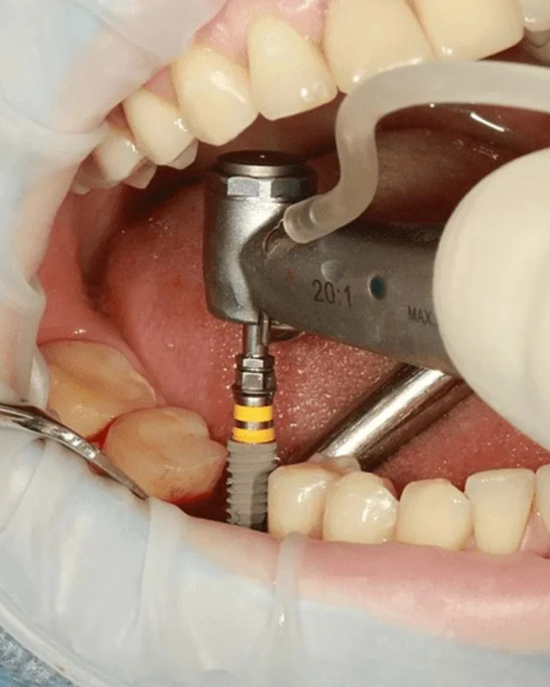 Dentista de Urgencias Murcia | Clínica Dental Ángel Samaniego - 2