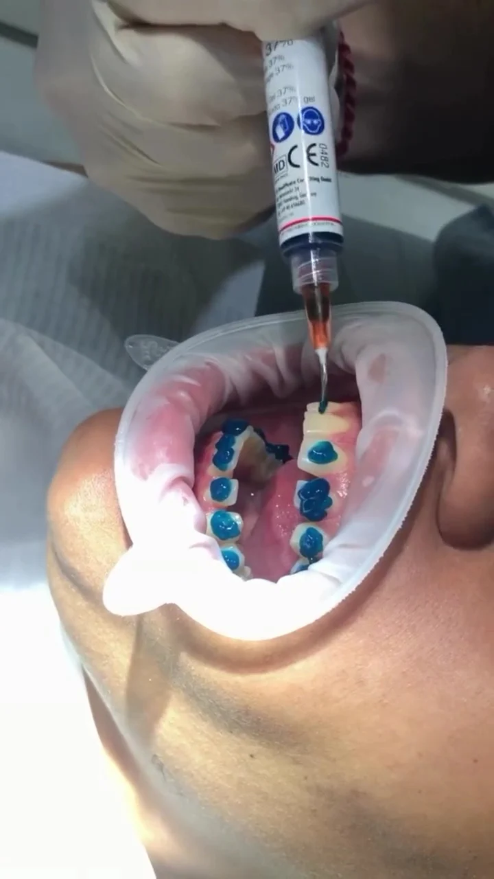 Denty Dent - Pueblo Nuevo - 2