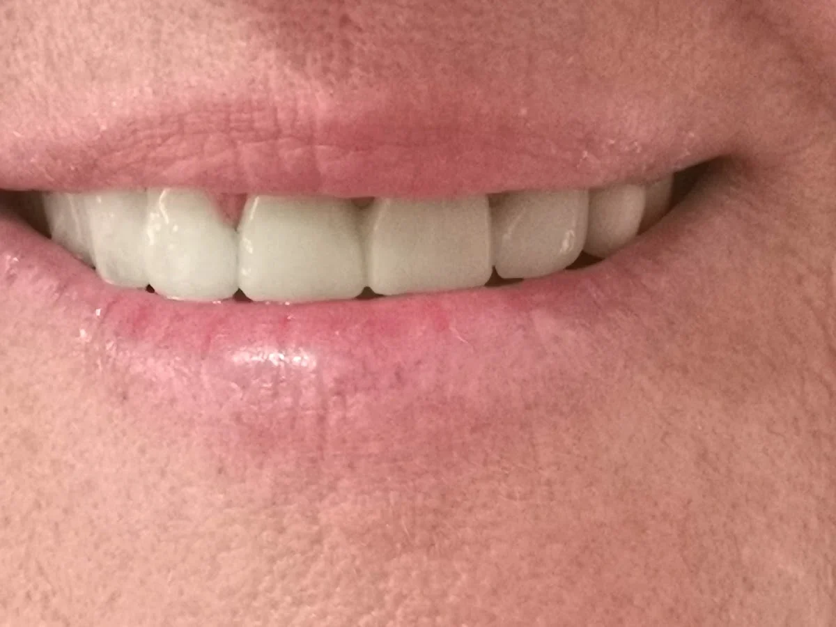 Dra. Hayarpi Ayvazyan | Especialista en Implantes Dentales