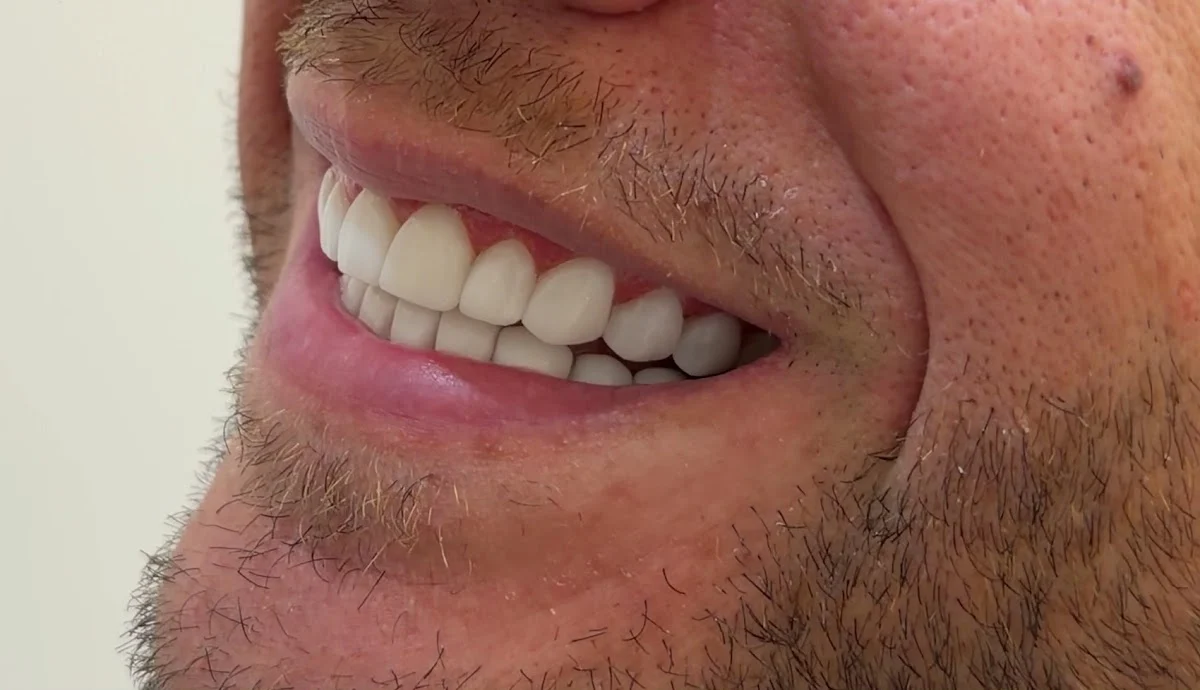 Harmony Clinic - Carillas Dentales Barcelona - Diseño de Sonrisa - 2