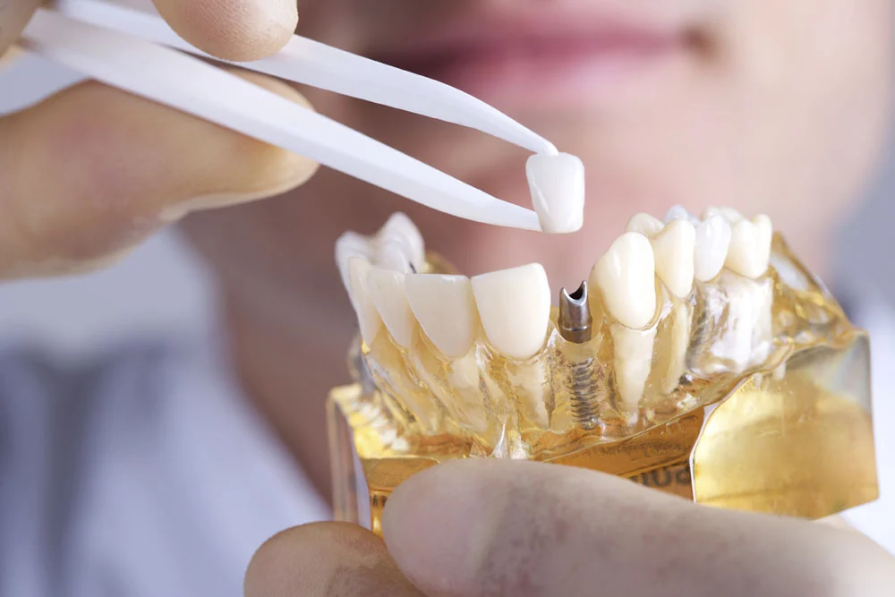 Kixx Dental - Jespicar - Aranjuez - 2