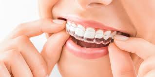 qué es invisalign